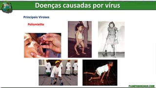 Doenças causadas por vírus
Principais Viroses
Poliomielite
 