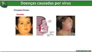 Doenças causadas por vírus
Principais Viroses
Caxumba
 