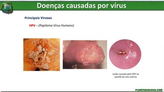 Doenças causadas por vírus
Principais Viroses
HPV – (Papiloma Vírus Humano)
Lesão causada pelo HPV na
parede do colo uterino
 
