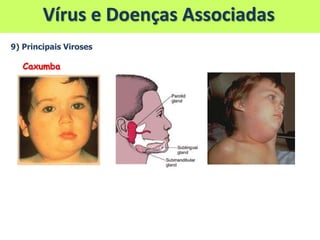 Vírus e Doenças Associadas
9) Principais Viroses
Caxumba
 
