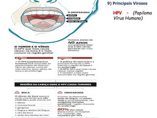 9) Principais Viroses
HPV – (Papiloma
Vírus Humano)
 