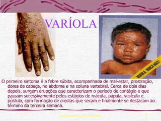 VARÍOLA



O primeiro sintoma é a febre súbita, acompanhada de mal-estar, prostração,
   dores de cabeça, no abdome e na coluna vertebral. Cerca de dois dias
   depois, surgem erupções que caracterizam o período de contágio e que
   passam sucessivamente pelos estágios de mácula, pápula, vesícula e
   pústula, com formação de crostas que secam e finalmente se destacam ao
   término da terceira semana.

                            Professora Ionara Urrutia Moura          8
 