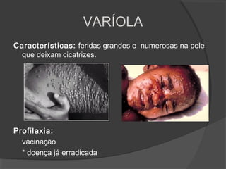 Características: feridas grandes e numerosas na pele
que deixam cicatrizes.
Profilaxia:
vacinação
* doença já erradicada
VARÍOLA
 