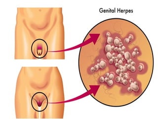 Catapora
Herpes zoster
Herpes simples
Vírus: Herpesvirus (DNA envelopado)
 