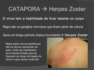 O virus tem a habilidade de ficar latente no corpo
Migra ate os ganglios nervosos que ficam perto da coluna
Apos um longo periodo (baixa imunidade) Herpes Zoster
CATAPORA  Herpes Zoster
Migra pelos nervos perifericos
ate os nervos sensoriais da
pele, onder se manifestam
provocando feridas que se
dispoem ao longo do trajeto do
nervo e que causa muita dor
 