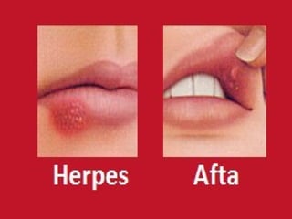 Herpes labial
Causador: HSV 1
(vírus do herpes simples tipo 1)
Fica latente no ganglio nervoso
do nervo trigemio
 