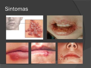 Sintomas
 