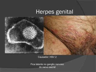 Herpes genital
Causador: HSV 2
Fica latente no ganglio nervoso
do nervo sacral
 