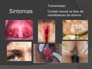 Sintomas
Transmissao:
Contato sexual na fase de
manifestacao da doenca
 