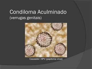 Condiloma Aculminado
(verrugas genitais)
Causador: HPV (papiloma vírus)
 