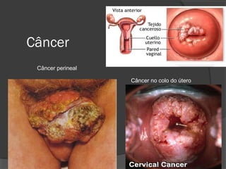Câncer
Câncer perineal
Câncer no colo do útero
 