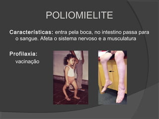 Características: entra pela boca, no intestino passa para
o sangue. Afeta o sistema nervoso e a musculatura
Profilaxia:
vacinação
POLIOMIELITE
 