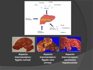 Aspecto
macroscópico:
fígado normal
Aspecto
macroscópico:
carcinoma
hepatocelular
Aspecto
macroscópico:
fígado com
cirrose
 