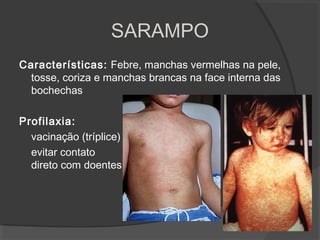 Características: Febre, manchas vermelhas na pele,
tosse, coriza e manchas brancas na face interna das
bochechas
Profilaxia:
vacinação (tríplice)
evitar contato
direto com doentes
SARAMPO
 