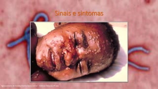 Sinais e sintomas
Agrupamento de Escolas Rainha Dona Leonor - Ciências Naturais 9º ano
 