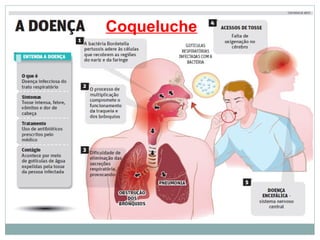Coqueluche
 