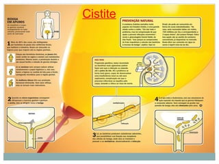 Cistite
 