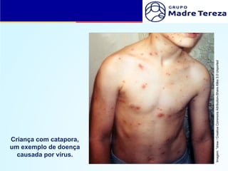 Criança com catapora,
um exemplo de doença
causada por vírus.
Imagem:
*drew
/
Creative
Commons
Attribution-Share
Alike
3.0
Unported
 