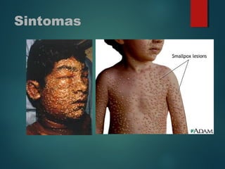 Sintomas
 