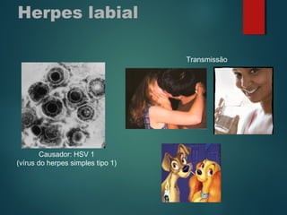 Herpes labial
Causador: HSV 1
(vírus do herpes simples tipo 1)
Transmissão
 