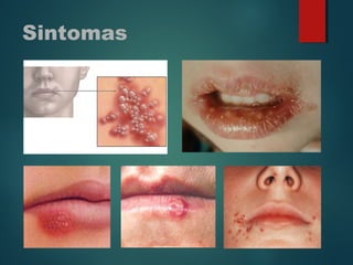 Sintomas
 