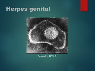 Herpes genital
Causador: HSV 2
 