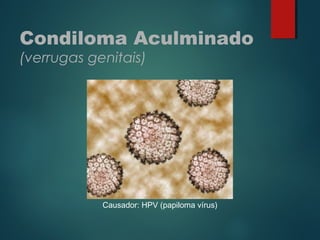 Condiloma Aculminado
(verrugas genitais)
Causador: HPV (papiloma vírus)
 
