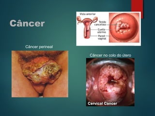 Câncer
Câncer perineal
Câncer no colo do útero
 