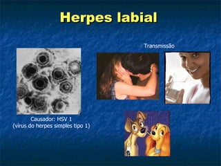 Herpes labial  Causador: HSV 1 (vírus do herpes simples tipo 1) Transmissão 