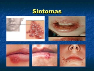 Sintomas 