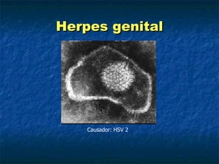 Herpes genital Causador: HSV 2 