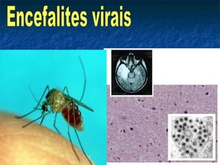Encefalites virais 