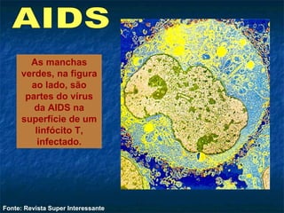 As manchas verdes, na figura ao lado, são partes do vírus da AIDS na superfície de um linfócito T, infectado. Fonte: Revista Super Interessante AIDS 