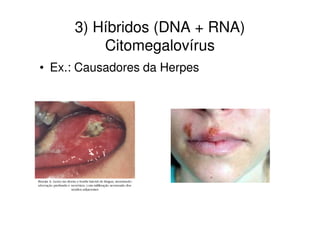 3) Híbridos (DNA + RNA)
         Citomegalovírus
• Ex.: Causadores da Herpes
 