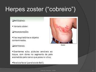 Herpes zoster (“cobreiro”)
Ciências Naturais - ICRM 22
 