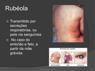 Rubéola
 Transmitido por
secreções
respiratórias, ou
pela via sanguínea.
 No caso do
embrião e feto, a
partir da mãe
grávida.
Ciências Naturais - ICRM 29
 
