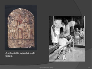 A poliomielite existe há muito
tempo.
Ciências Naturais - ICRM 31
 