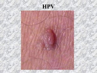 HPV 
