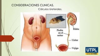 CONSIDERACIONES CLINICAS.
Cálculos Ureterales.

 