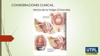 CONSIDERACIONES CLINICAS.
Hernia de la Vejiga (Cistocele)

 