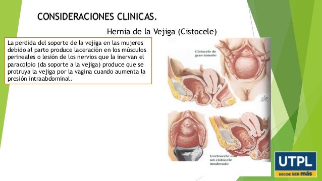 La hernia sheynogo del departamento de la complicación