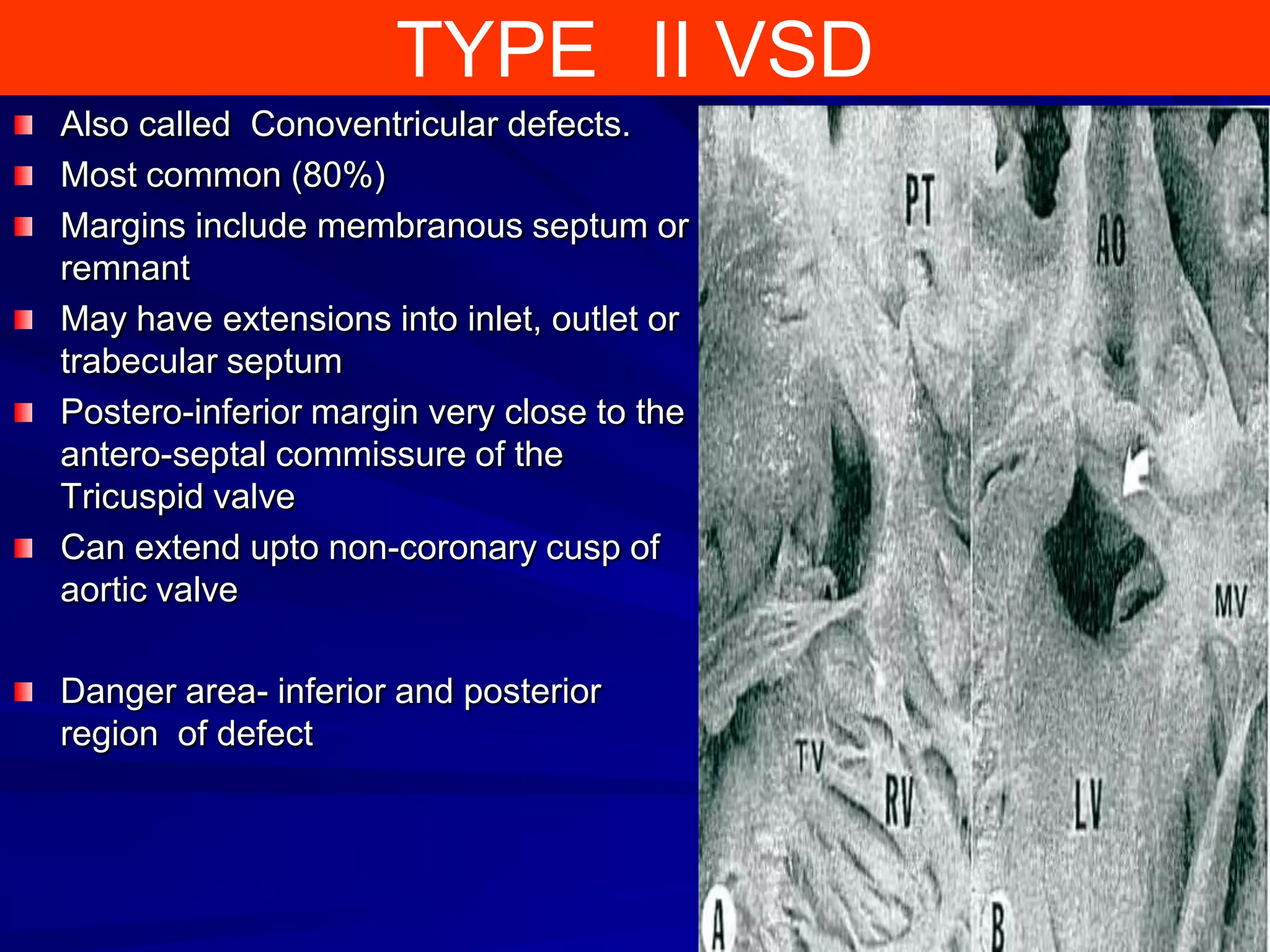 TYPE II VSD
Also called Conoventricular defects.
Most common (80%)
Margins include membranous septum or
remnant
May have extensions into inlet, outlet or
trabecular septum
Postero-inferior margin very close to the
antero-septal commissure of the
Tricuspid valve
Can extend upto non-coronary cusp of
aortic valve
Danger area- inferior and posterior
region of defect

 