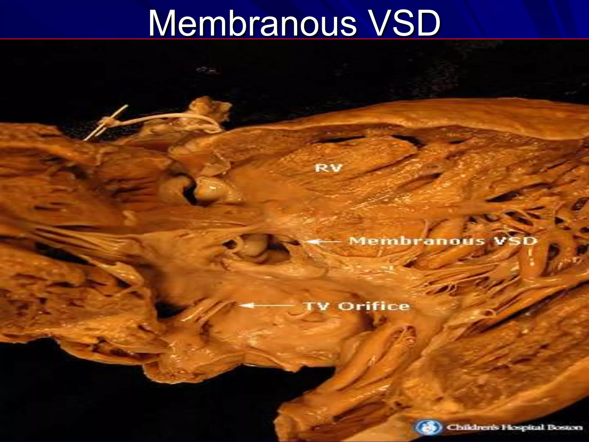 Membranous VSD

 
