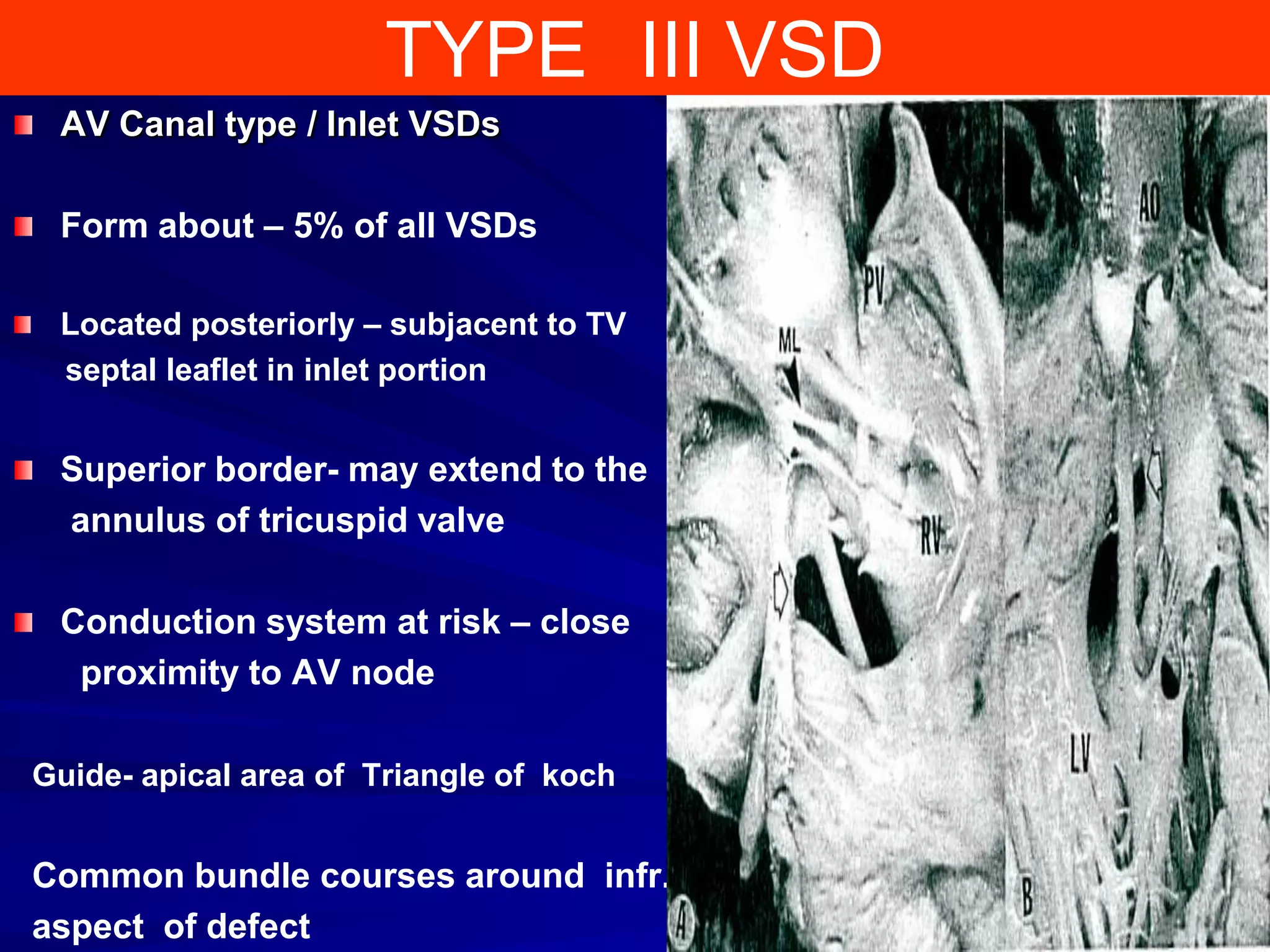 TYPE III VSD
AV Canal type / Inlet VSDs
Form about – 5% of all VSDs
Located posteriorly – subjacent to TV
septal leaflet in inlet portion

Superior border- may extend to the
annulus of tricuspid valve
Conduction system at risk – close
proximity to AV node
Guide- apical area of Triangle of koch

Common bundle courses around infr.
aspect of defect

 
