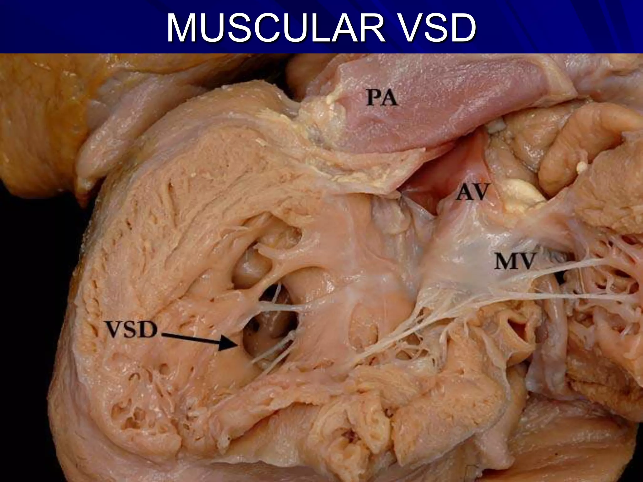 MUSCULAR VSD

 