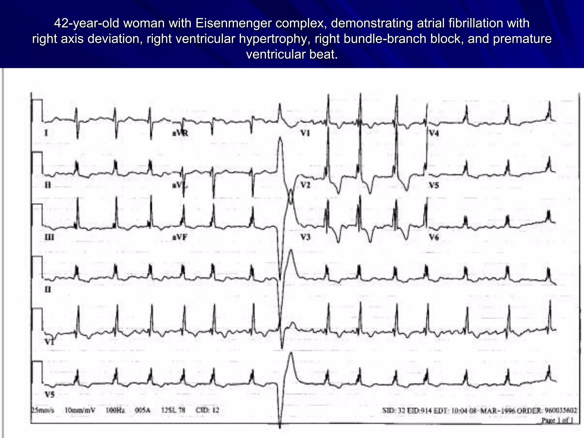 42-year-old woman with Eisenmenger complex, demonstrating atrial fibrillation with
right axis deviation, right ventricular hypertrophy, right bundle-branch block, and premature
ventricular beat.

 