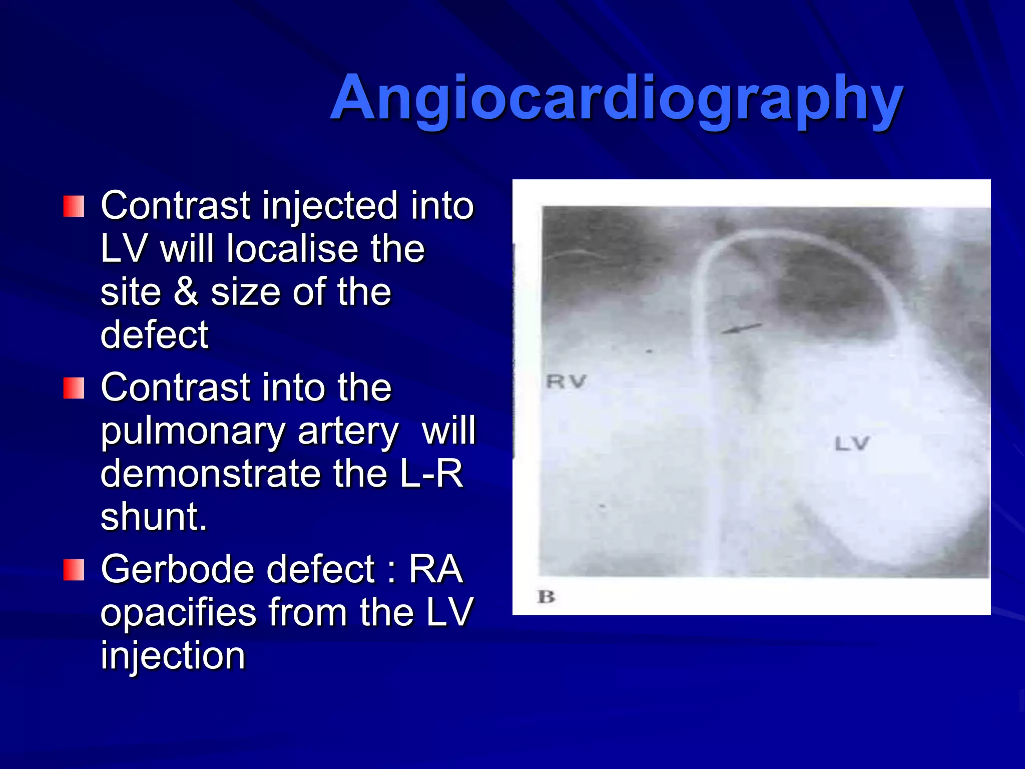 Angiocardiography
Contrast injected into
LV will localise the
site & size of the
defect
Contrast into the
pulmonary artery will
demonstrate the L-R
shunt.
Gerbode defect : RA
opacifies from the LV
injection

 