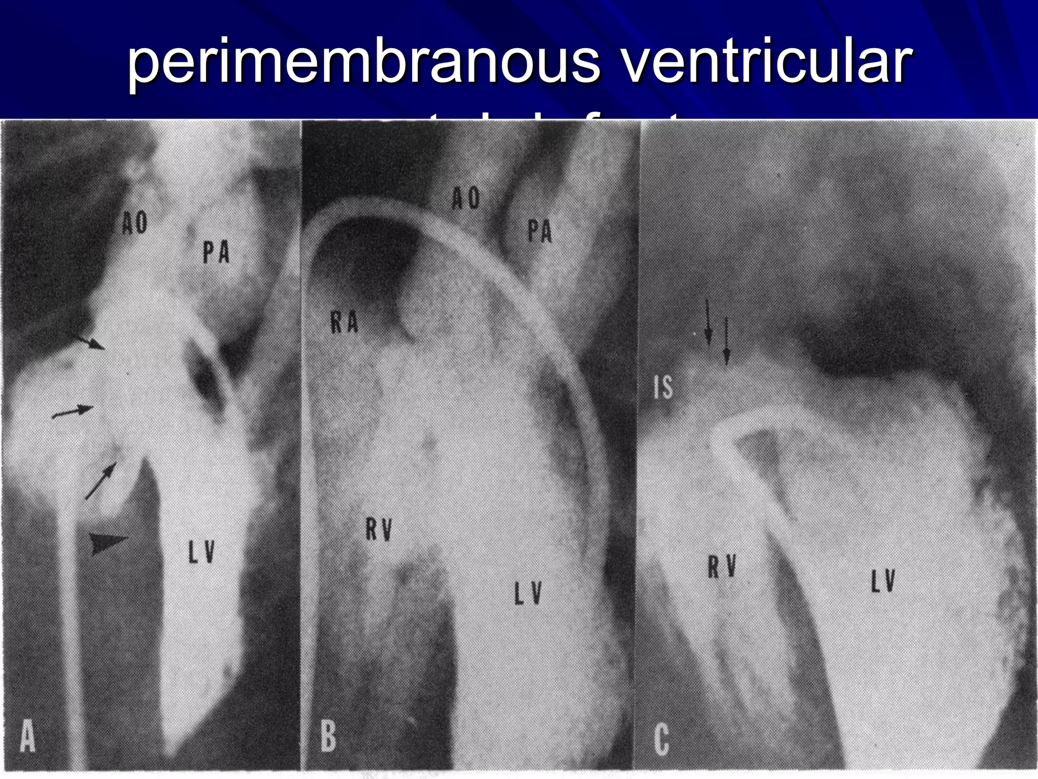 perimembranous ventricular
septal defects

 