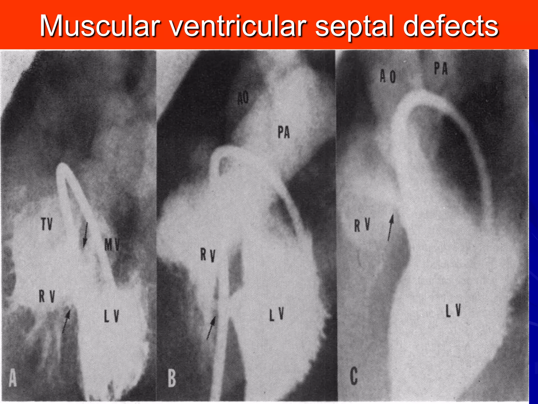 Muscular ventricular septal defects

 