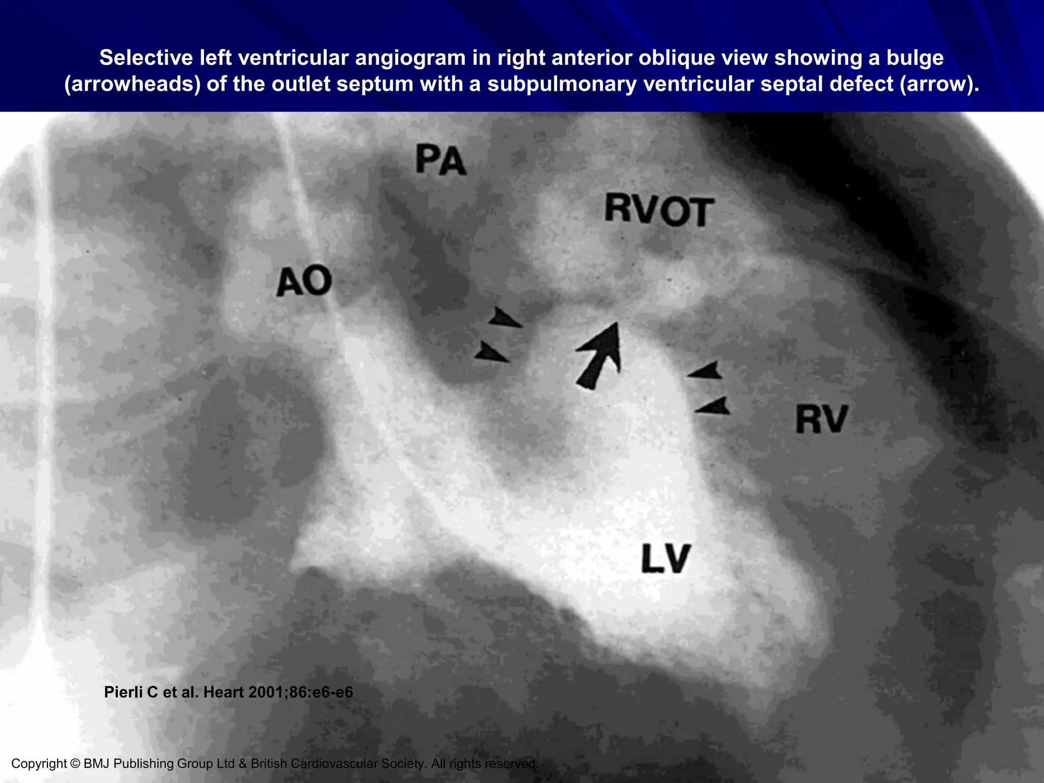 Selective left ventricular angiogram in right anterior oblique view showing a bulge
(arrowheads) of the outlet septum with a subpulmonary ventricular septal defect (arrow).

Pierli C et al. Heart 2001;86:e6-e6

Copyright © BMJ Publishing Group Ltd & British Cardiovascular Society. All rights reserved.

 